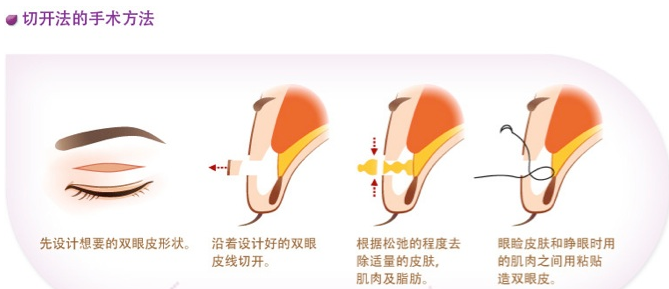 雙眼皮切開法