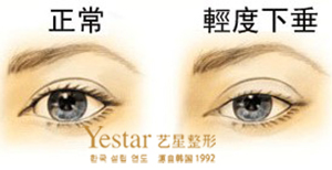 雙眼皮下垂