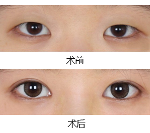 內眥贅皮術效果圖
