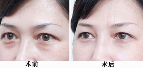 藝星激光法去眼袋對比圖