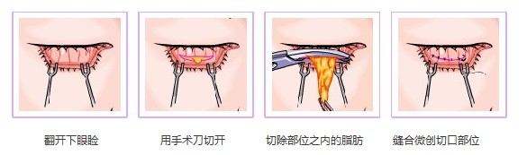 內路法過程