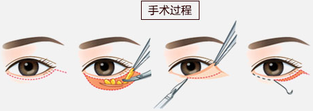祛眼袋外路法