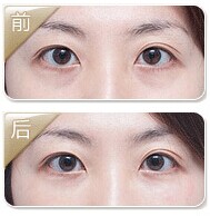 藝星祛眼袋效果圖