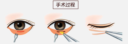 祛眼袋內(nèi)路法