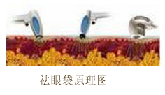 祛眼袋原理圖