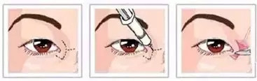開上眼角示意圖