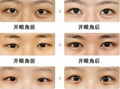 開眼角案例圖