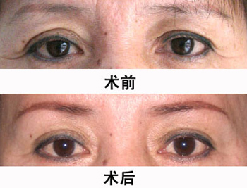 提眉術效果圖