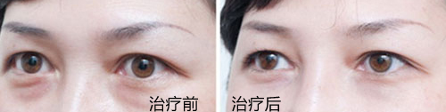去黑眼圈前后對比