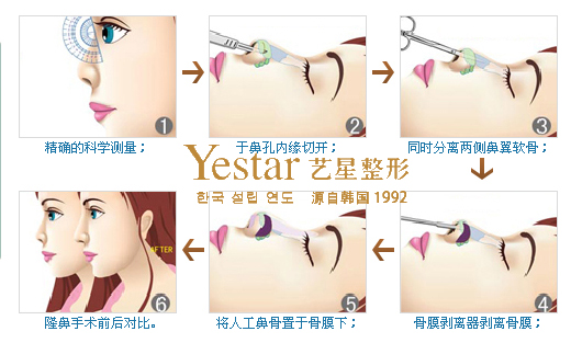 假體隆鼻過程