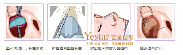 假體隆鼻過程