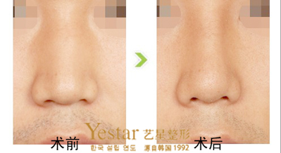 下巴整形內(nèi)退改善寬鼻前后對(duì)比